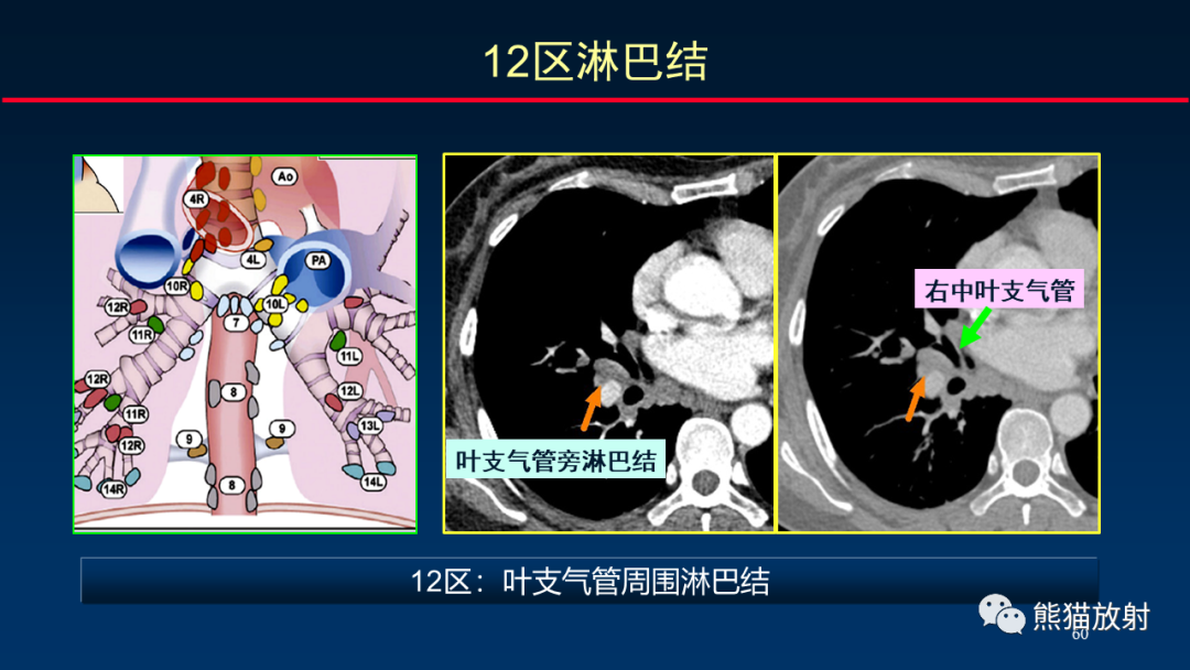 【PPT】纵隔与肺门淋巴结的识别与精准CT分区-60