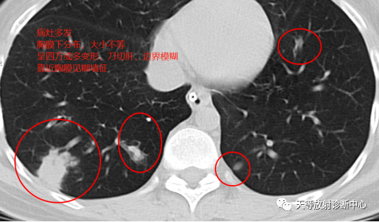【病例】肺非结核分枝杆菌(NTM-PD)一例CT影像-4
