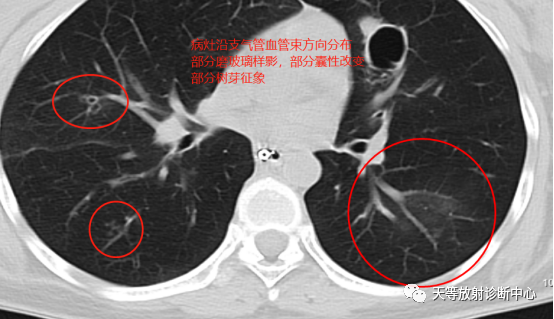 【病例】肺非结核分枝杆菌(NTM-PD)一例CT影像-2