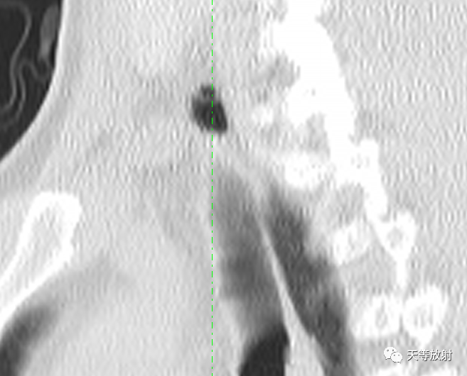 【病例】气管憩室1例CT影像-8