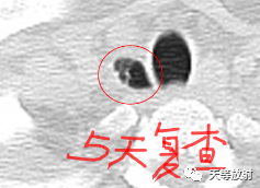 【病例】气管憩室1例CT影像-2