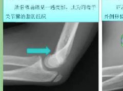 儿童肘关节骨折的X线诊断
