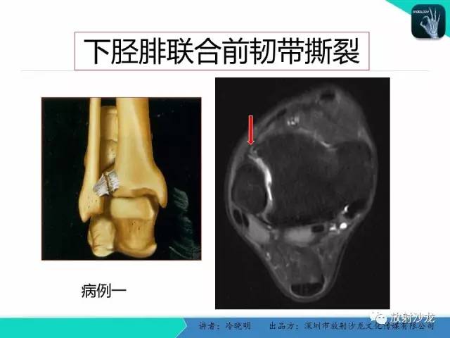 【PPT】基于损伤机制的踝关节急性损伤的影像学评估