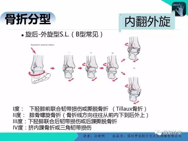【PPT】基于损伤机制的踝关节急性损伤的影像学评估