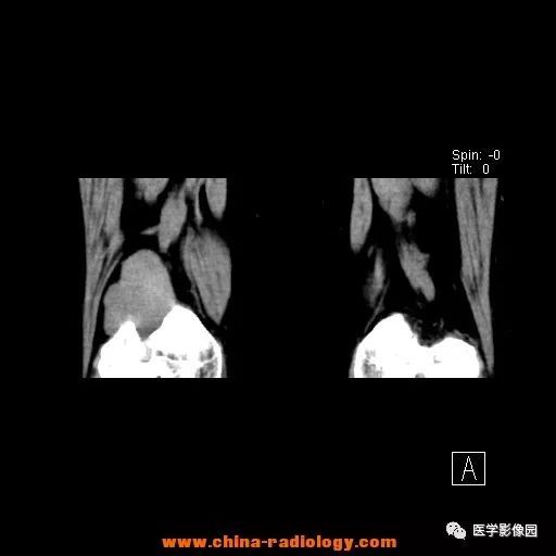【病例】股骨下端梭形细胞瘤1例CT