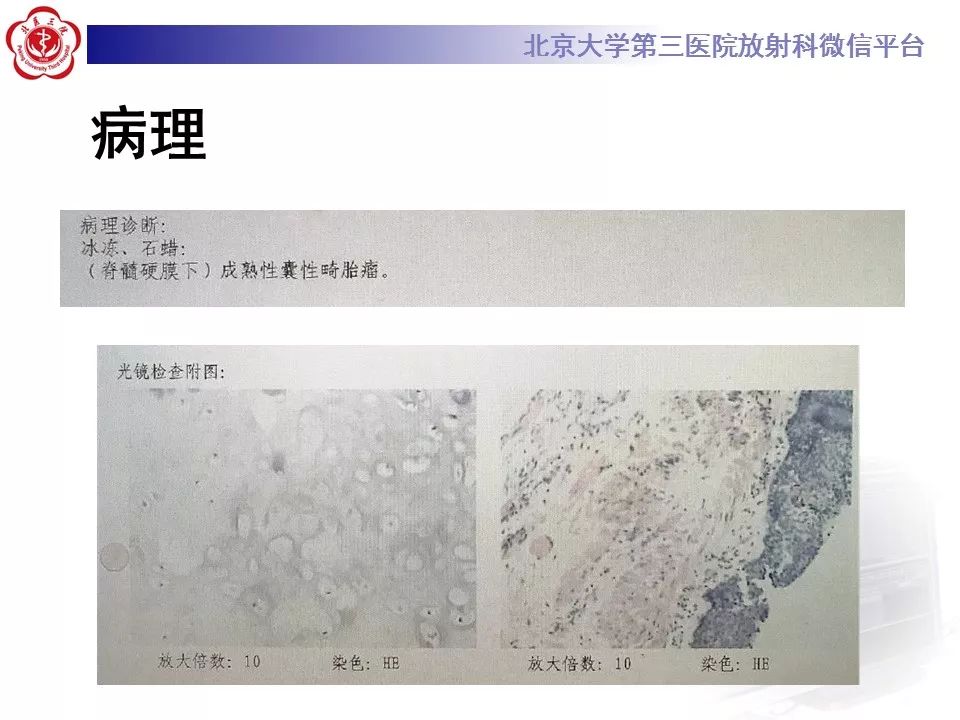 【病例】椎管内髓外硬膜下畸胎瘤1例