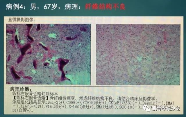 【病例】股骨近端占位性病变4例影像讨论