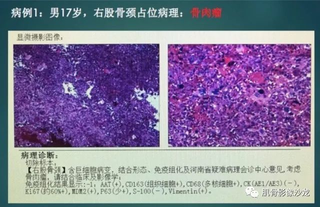 【病例】股骨近端占位性病变4例影像讨论