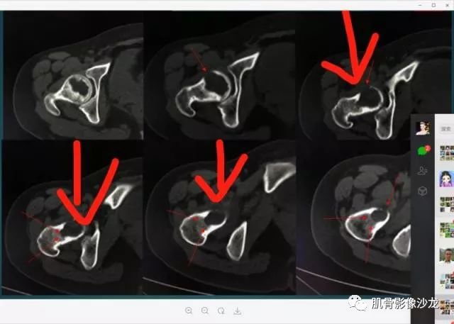 【病例】股骨近端占位性病变4例影像讨论