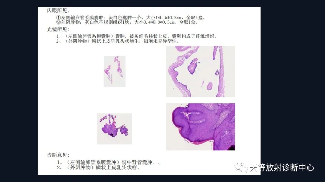 【病例】中肾管囊肿/卵巢冠囊肿1例MR影像-20