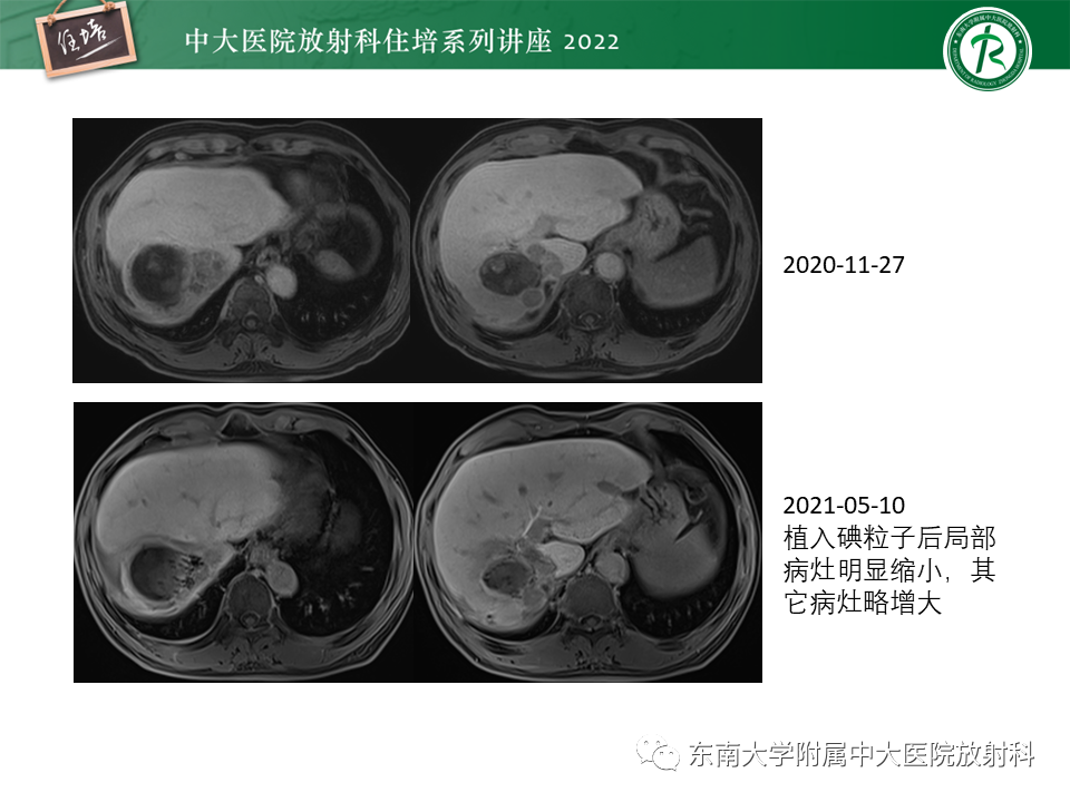 【PPT】肝癌介入治疗后的磁共振评估-42