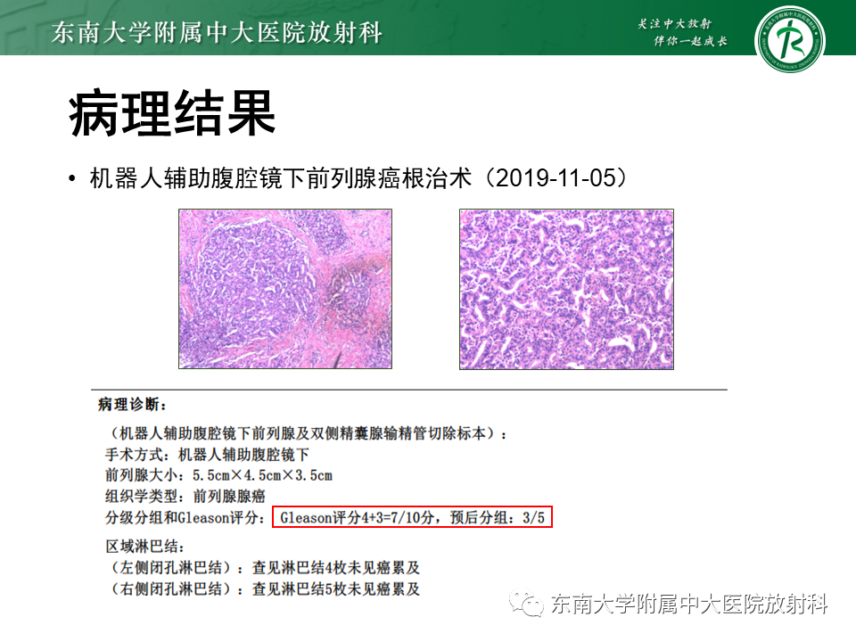 【PPT】前列腺癌-6