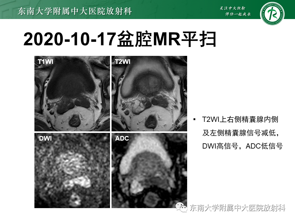 【PPT】前列腺癌-19