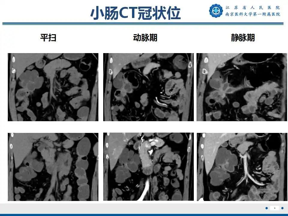 【PPT】克罗恩病-6