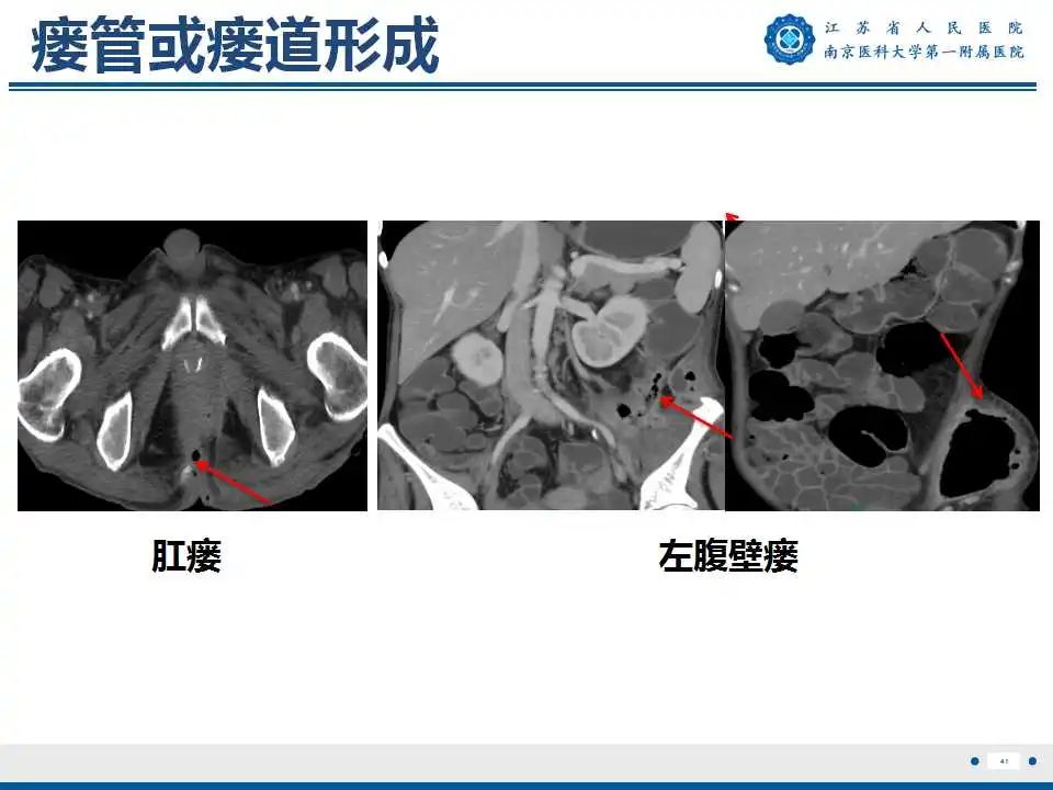 【PPT】克罗恩病-42