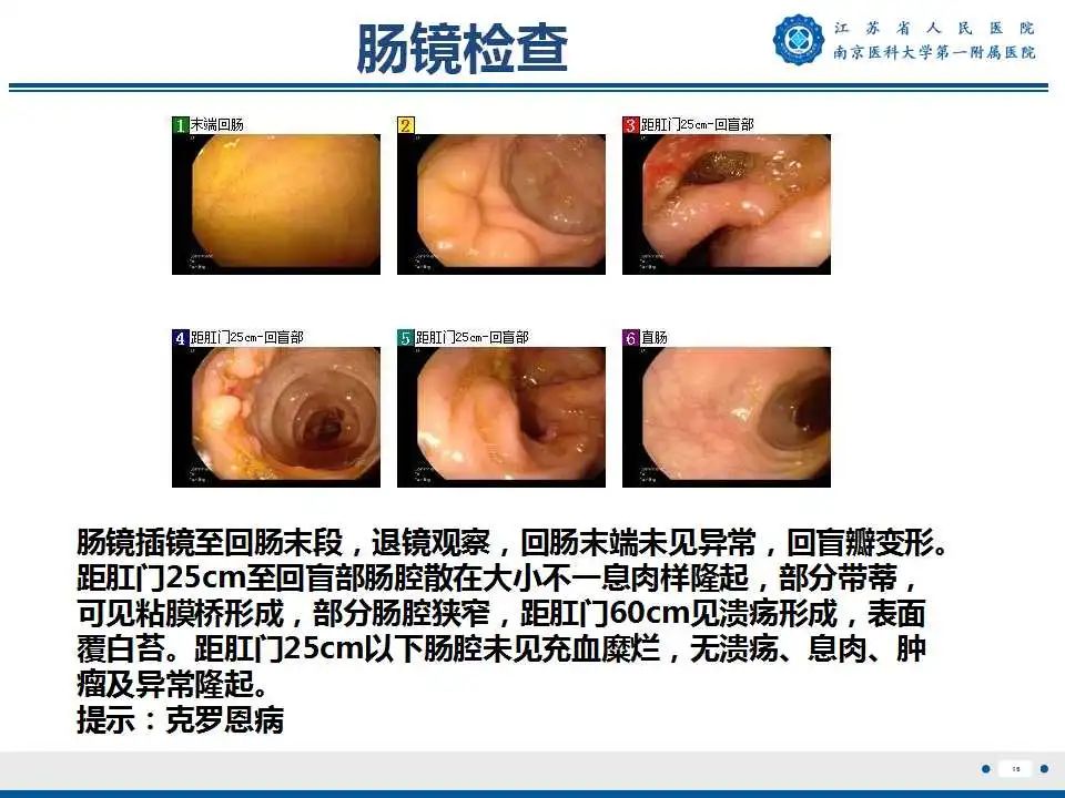 【PPT】克罗恩病-17