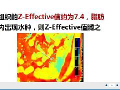 克罗恩病