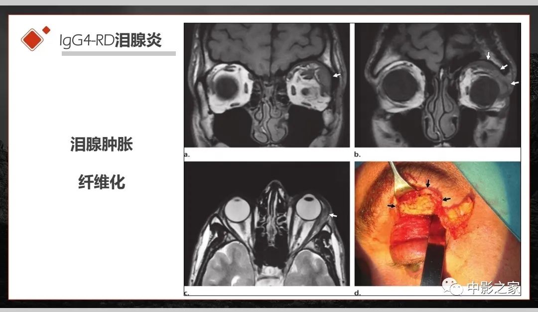 【PPT】肾脏IgG4-RD临床、病理及影像特征-10