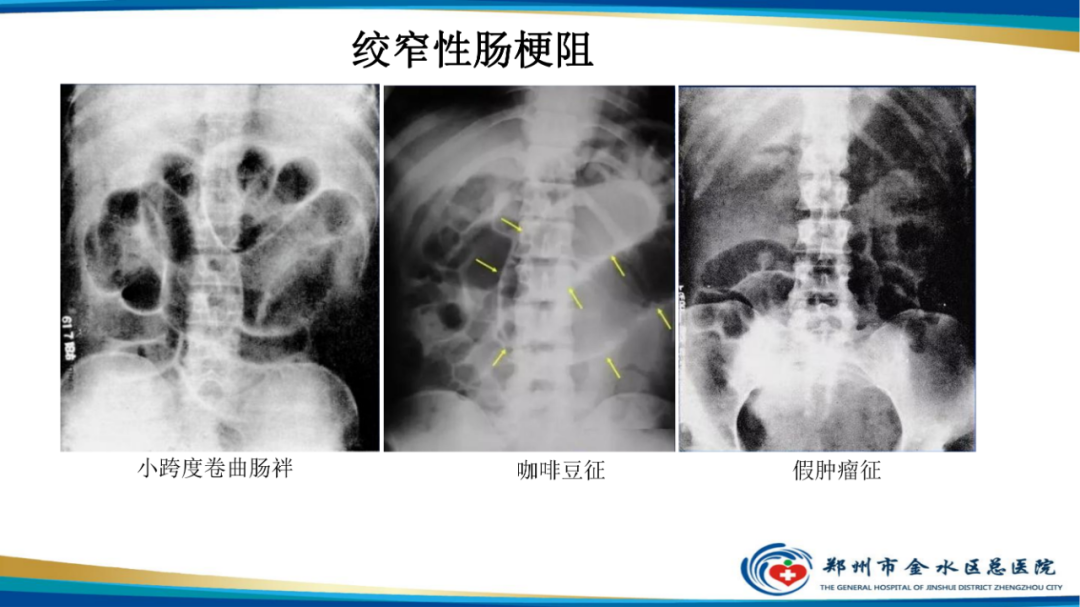 【PPT】常见急腹症的影像学诊断-13