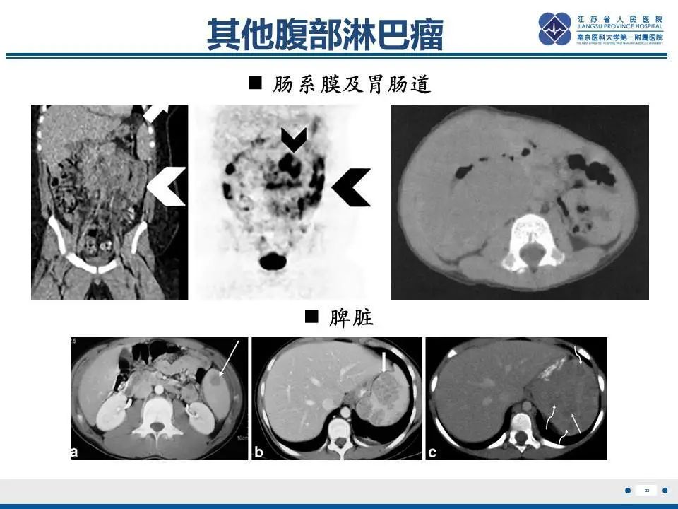 【PPT】肝淋巴瘤-24
