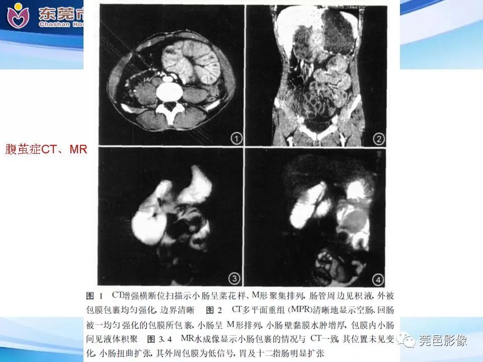 【PPT】腹茧症的影像诊断-44