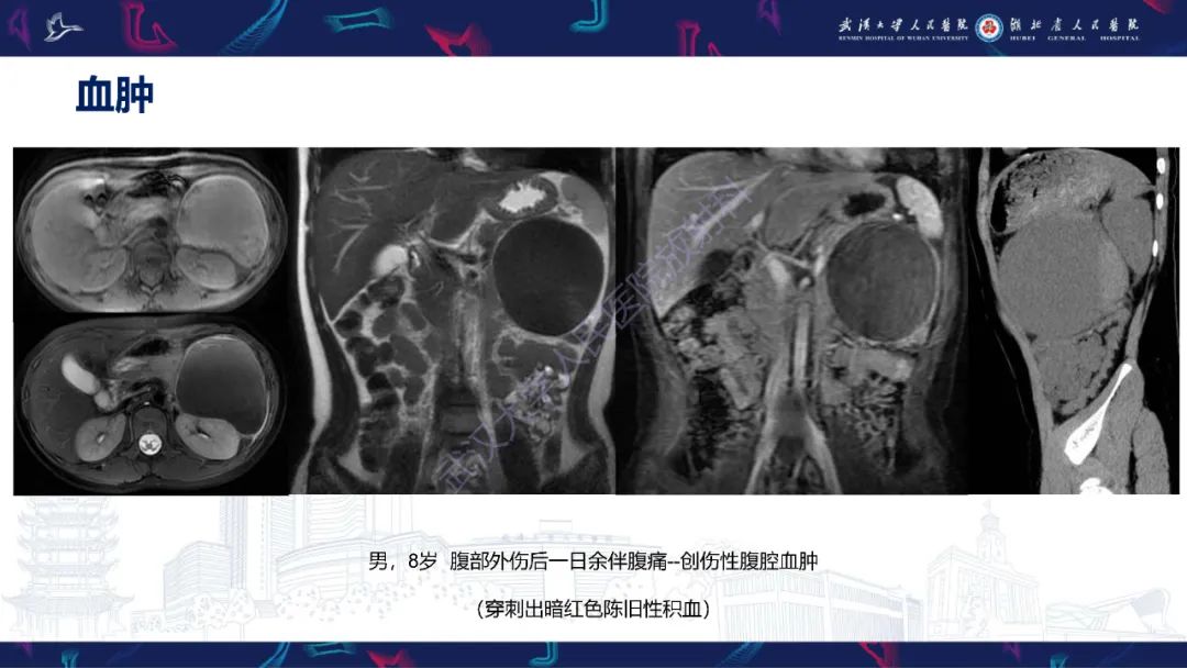 【PPT】盆腹腔巨大占位性病变影像诊断-10