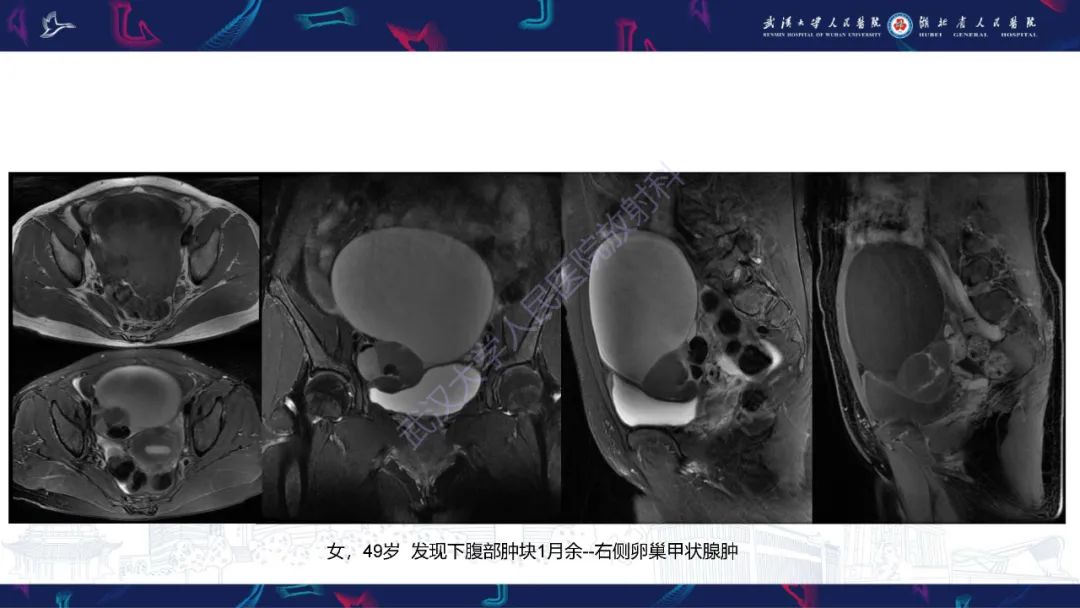 【PPT】盆腹腔巨大占位性病变影像诊断-36