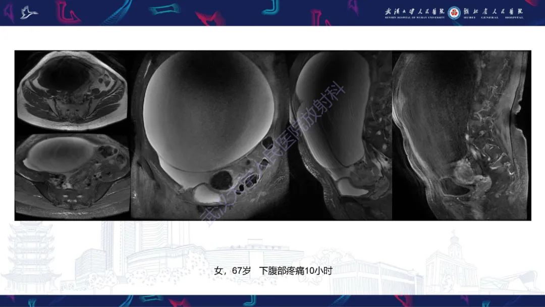 【PPT】盆腹腔巨大占位性病变影像诊断-3