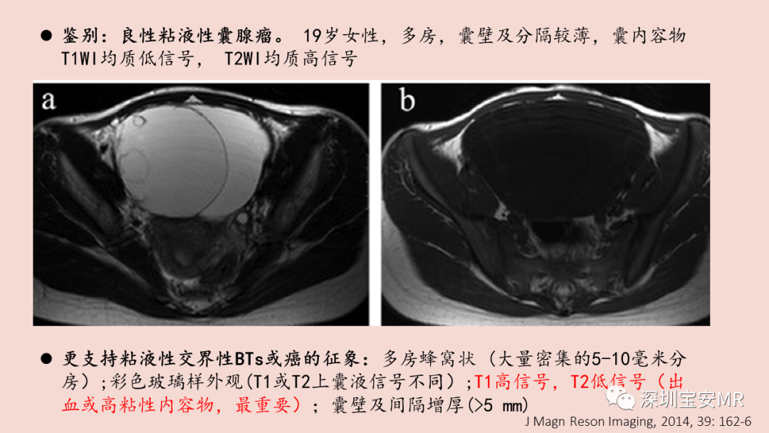 【PPT】卵巢交界性上皮性肿瘤MRI与病理对照-28