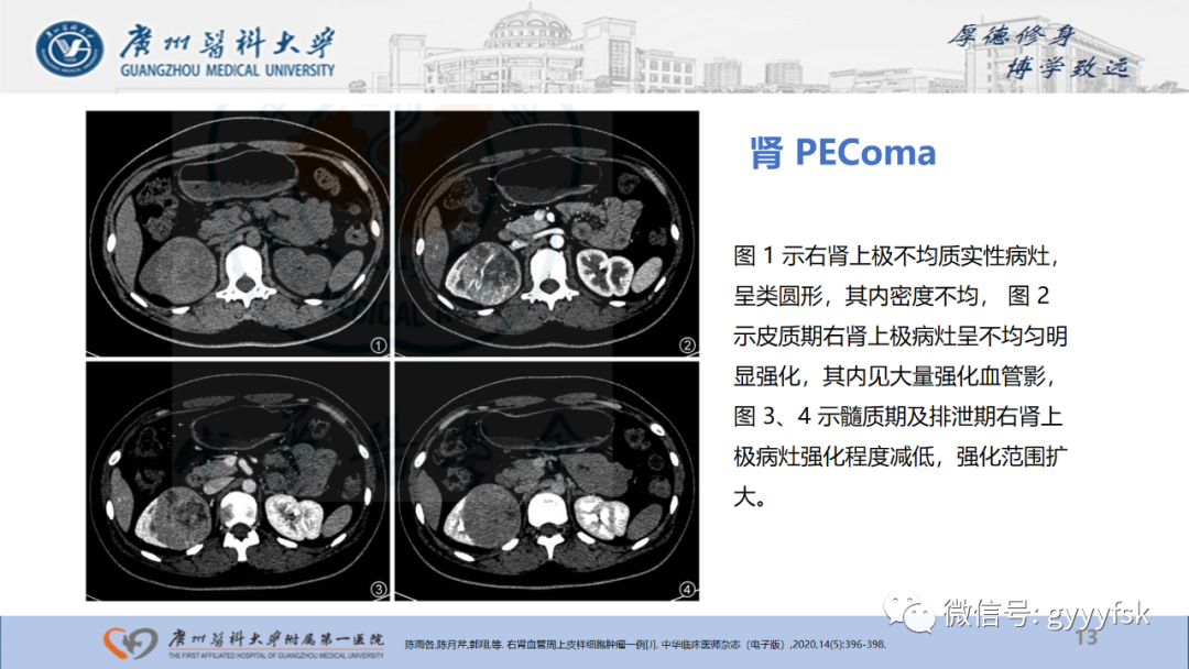 【PPT】肾少见肿瘤影像诊断的文献汇报-13