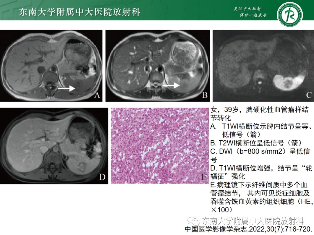 【PPT】脾脏硬化性血管瘤样结节性转化-10
