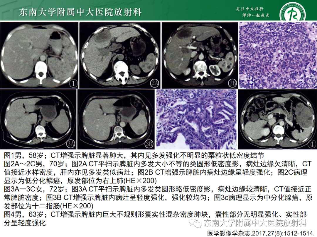 【PPT】脾脏硬化性血管瘤样结节性转化-36