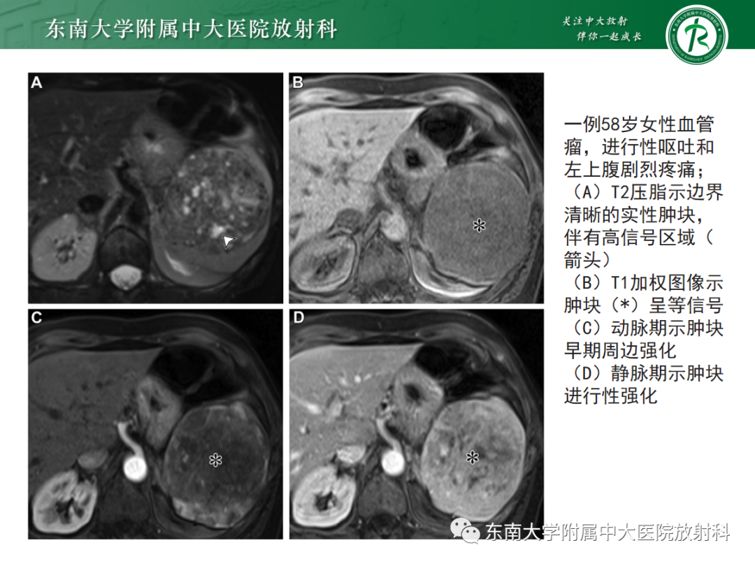 【PPT】脾脏硬化性血管瘤样结节性转化-16