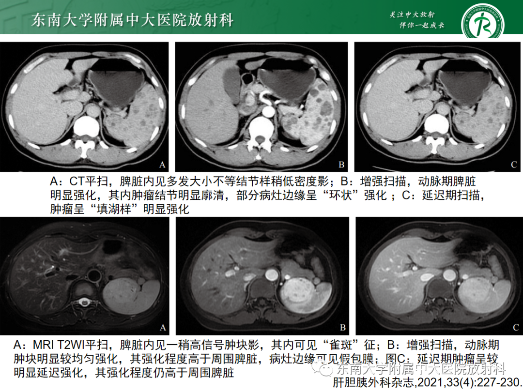 【PPT】脾脏硬化性血管瘤样结节性转化-24