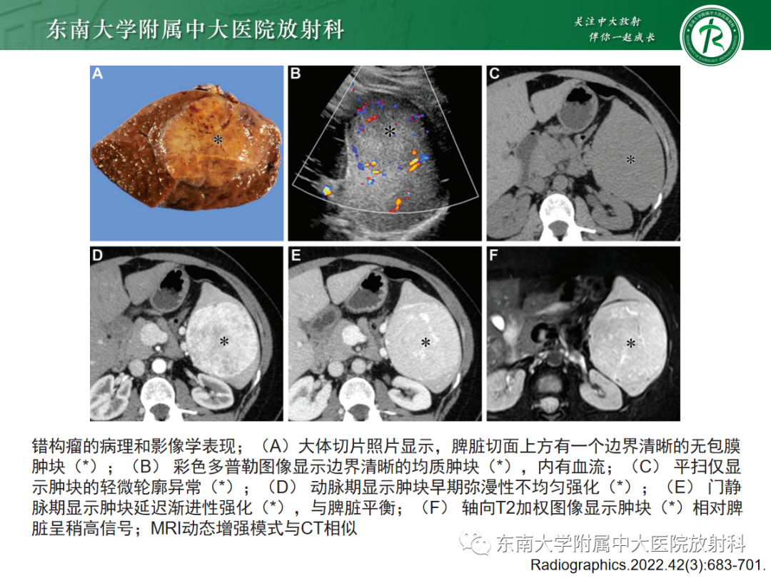 【PPT】脾脏硬化性血管瘤样结节性转化-20