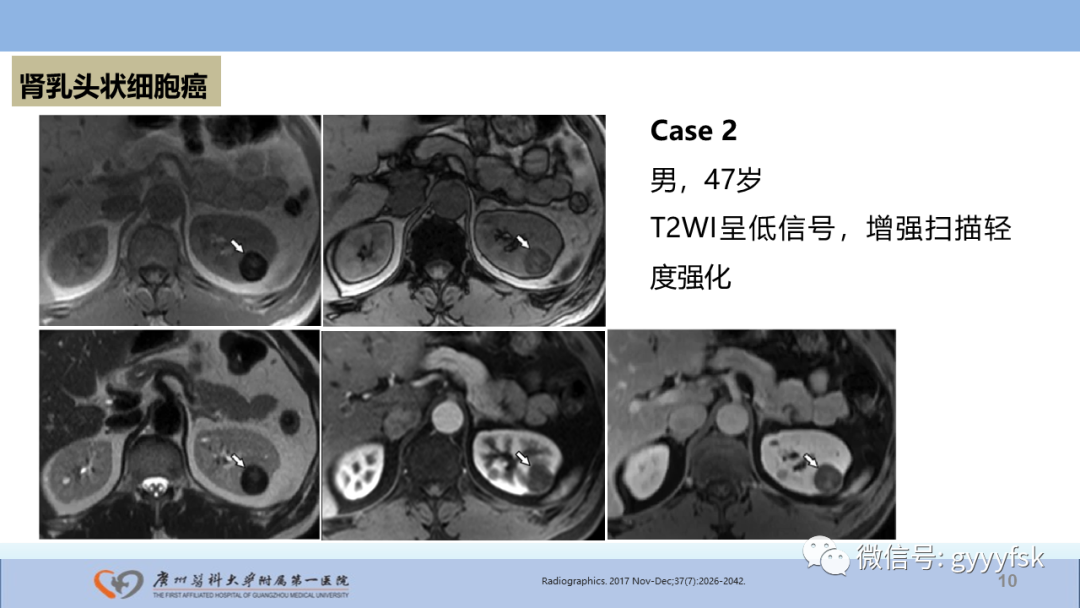【PPT】肾癌相关影像诊断的文献汇报-10