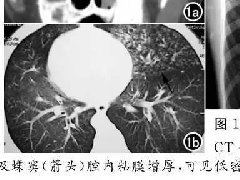 当支气管扩张遇上右位心 ——Kartagener综合征