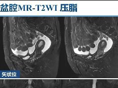 输卵管结核