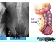 缺血性肠病的影像学表现