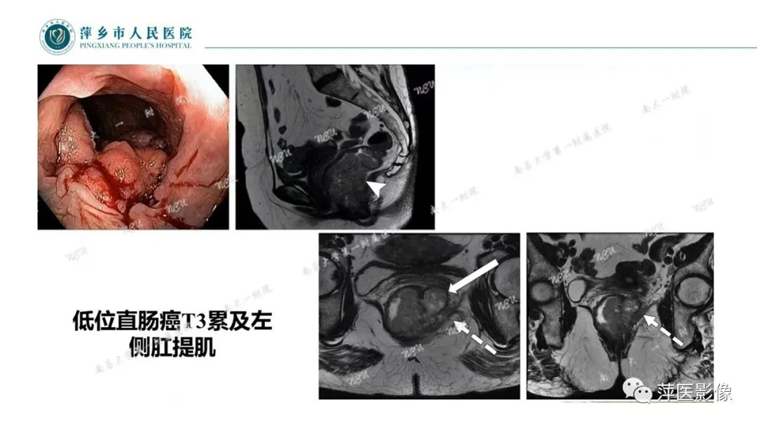 【PPT】直肠癌MR分期-40