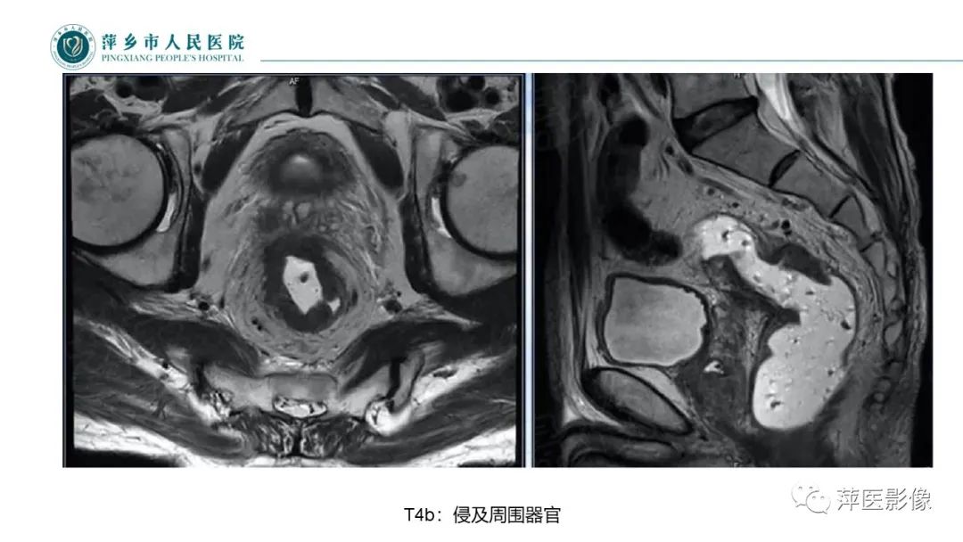 【PPT】直肠癌MR分期-37