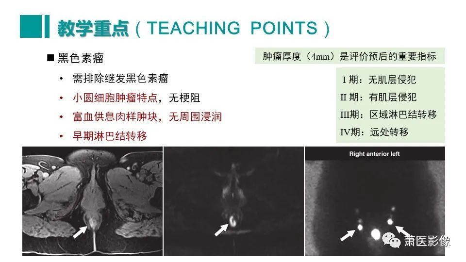 【PPT】肛管及肛周区域病变MRI影像特征-55