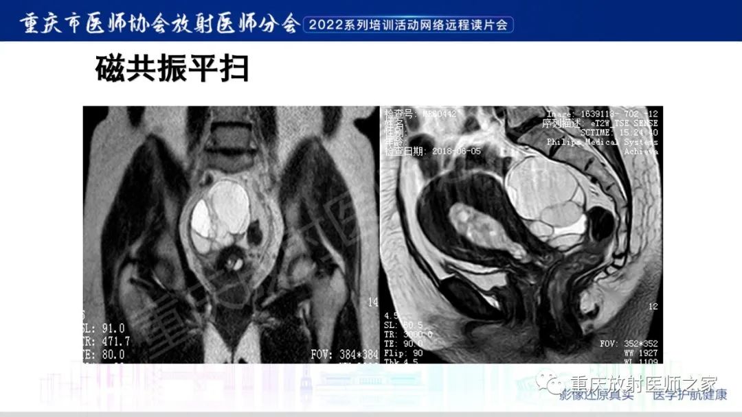 【病例】卵巢黏液性囊腺瘤合并子宫内膜异位1例MR-5