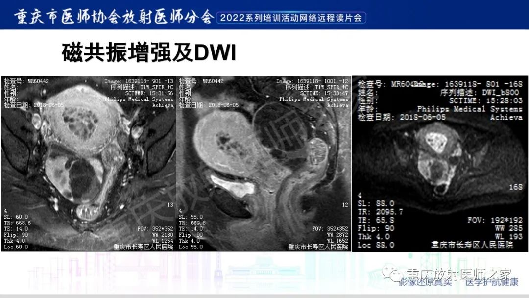 【病例】卵巢黏液性囊腺瘤合并子宫内膜异位1例MR-6