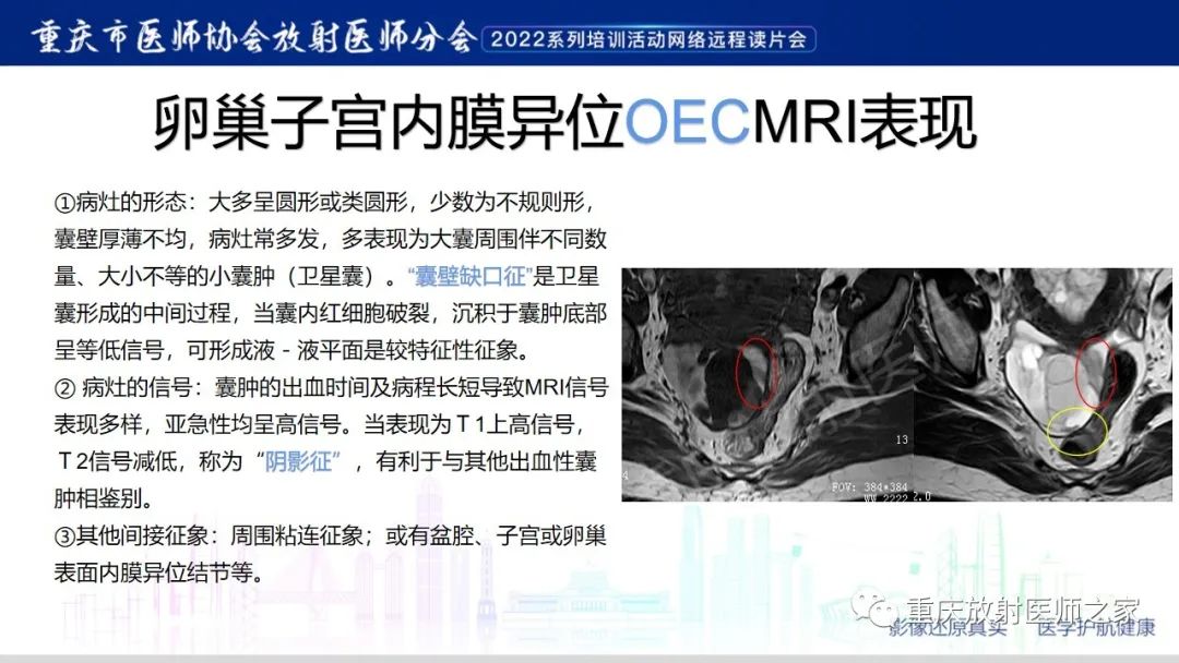 【病例】卵巢黏液性囊腺瘤合并子宫内膜异位1例MR-16