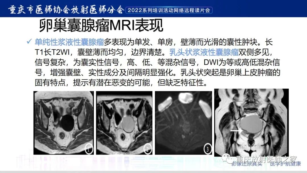 【病例】卵巢黏液性囊腺瘤合并子宫内膜异位1例MR-14