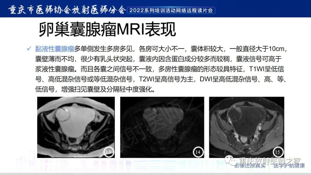 【病例】卵巢黏液性囊腺瘤合并子宫内膜异位1例MR-15