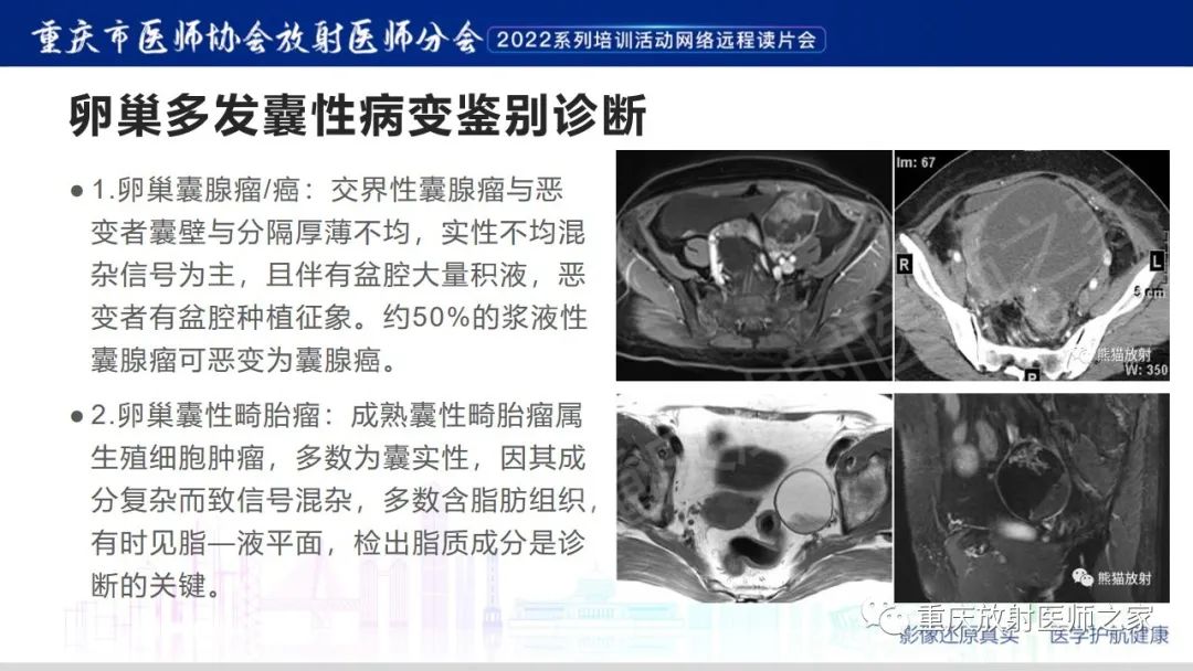 【病例】卵巢黏液性囊腺瘤合并子宫内膜异位1例MR-17
