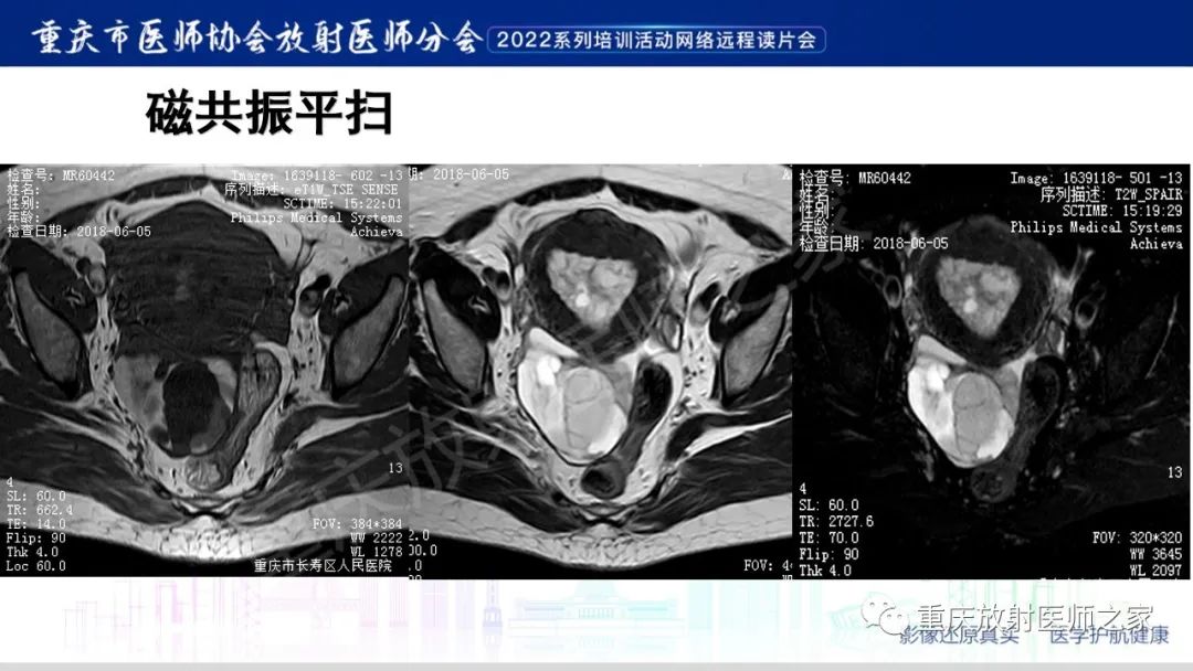 【病例】卵巢黏液性囊腺瘤合并子宫内膜异位1例MR-4