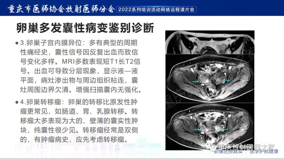 【病例】卵巢黏液性囊腺瘤合并子宫内膜异位1例MR-18